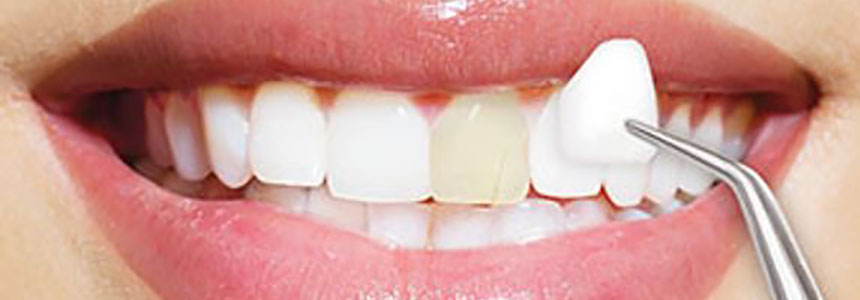 Dr Fernandes Porcelain Veneers