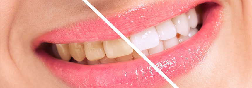 Dr Fernandes Tooth whitening